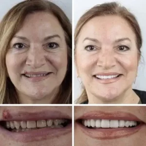 CLINCLII™ –Advanced Customized Full Denture Set