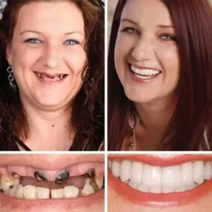 CLINCLII™ –Advanced Customized Full Denture Set