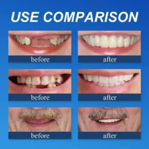 CLINCLII™ –Advanced Customized Full Denture Set