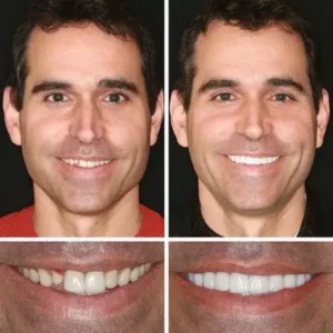 CLINCLII™ –Advanced Customized Full Denture Set