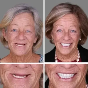 CLINCLII™ –Advanced Customized Full Denture Set