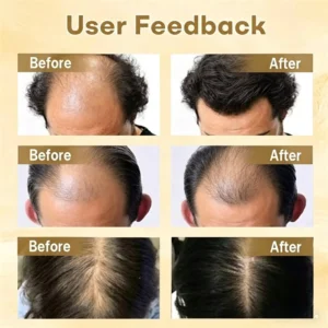 🔥Clinclii Hair Regrowth Capsules - Nano Penetration, Deep into Hair Roots🎉𝙇𝙞𝙢𝙞𝙩𝙚𝙙-𝙏𝙞𝙢𝙚 𝙊𝙛𝙛𝙚𝙧