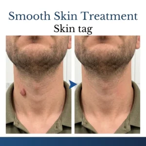✨Buy 1 Get 1 FREE Today Only – Clinclii® DermFixPro 2-in-1 Microneedle & Hydrocolloid Patch