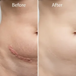 CLINCLII Advanced Silicone Scar & Wrinkle Smoothing Gel